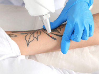 Laser Tattoo Removal Guide Form - Victoria's