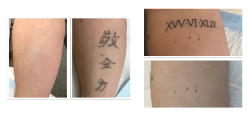 Plastic surgeons and tattoo removalists call for more regulation of the  laser tattoo removal industry -