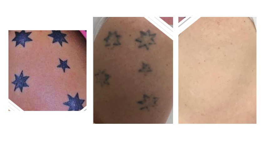 Techniques for Painless Tattoo Removal | OpenGrowth